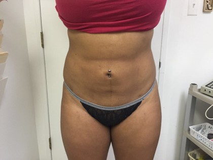 Liposuction Before & After Patient #4931