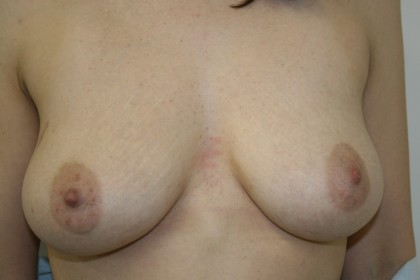 Breast Reconstruction Before & After Patient #4941
