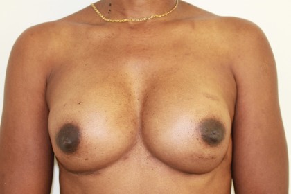 Breast Augmentation Before & After Patient #4951