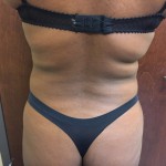 Brazilian Butt Lift Before & After Patient #4944