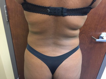 Brazilian Butt Lift Before & After Patient #4944