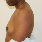 Breast Augmentation Before & After Patient #4951