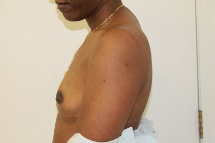 Breast Augmentation Before & After Patient #4951