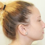Rhinoplasty Before & After Patient #4975
