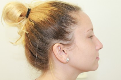 Rhinoplasty Before & After Patient #4975