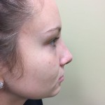 Rhinoplasty Before & After Patient #4975