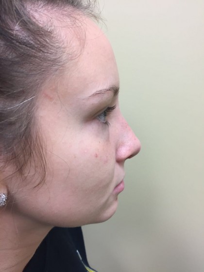 Rhinoplasty Before & After Patient #4975
