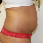 Liposuction Before & After Patient #4931