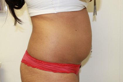 Liposuction Before & After Patient #4931