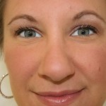 Rhinoplasty Before & After Patient #3994