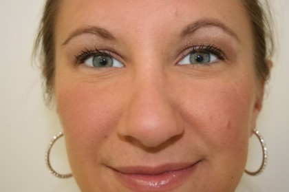 Rhinoplasty Before & After Patient #3994