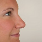 Rhinoplasty Before & After Patient #3994