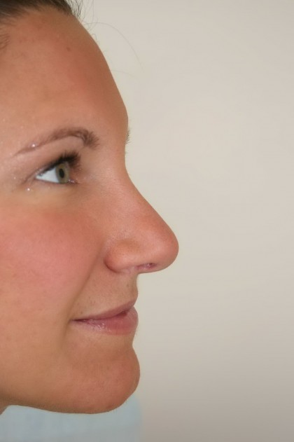 Rhinoplasty Before & After Patient #3994