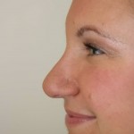 Rhinoplasty Before & After Patient #3994