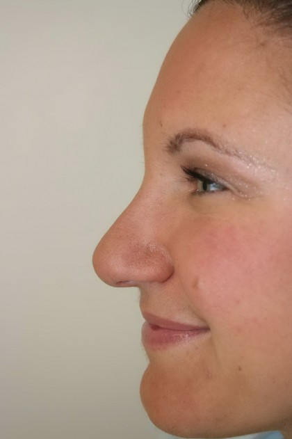 Rhinoplasty Before & After Patient #3994