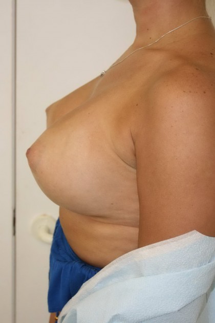 Breast Augmentation Before & After Patient #4003