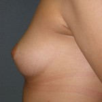 Breast Augmentation Before & After Patient #5030