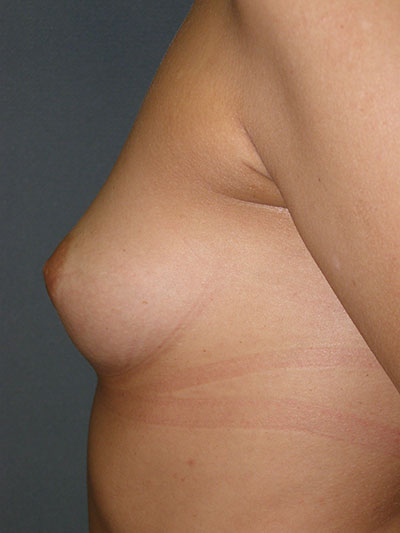 Breast Augmentation Before & After Patient #5030