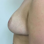 Breast Reduction Before & After Patient #5025