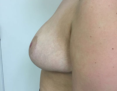 Breast Reduction Before & After Patient #5025