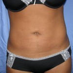 Liposuction Before & After Patient #5018