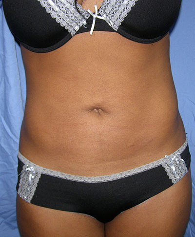 Liposuction Before & After Patient #5018