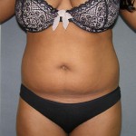 Liposuction Before & After Patient #5018