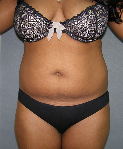 Liposuction Before & After Patient #5018