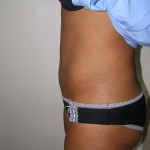 Liposuction Before & After Patient #5018
