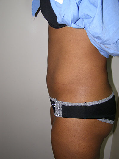 Liposuction Before & After Patient #5018