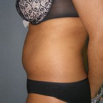 Liposuction Before & After Patient #5018