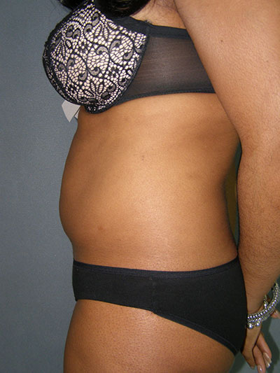 Liposuction Before & After Patient #5018