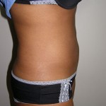 Liposuction Before & After Patient #5018