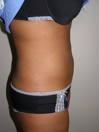 Liposuction Before & After Patient #5018