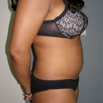 Liposuction Before & After Patient #5018