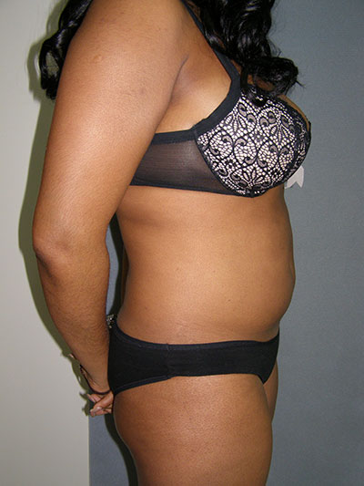 Liposuction Before & After Patient #5018