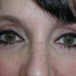 Eyelid Surgery Before & After Patient #4960