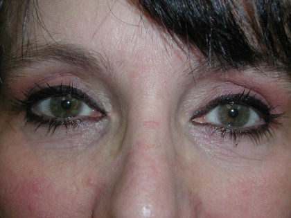 Eyelid Surgery Before & After Patient #4960