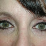Eyelid Surgery Before & After Patient #4960