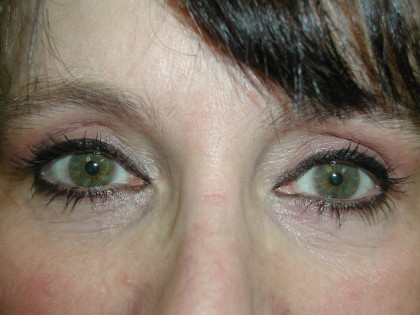 Eyelid Surgery Before & After Patient #4960