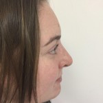 Rhinoplasty Before & After Patient #5012