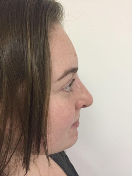 Rhinoplasty Before & After Patient #5012