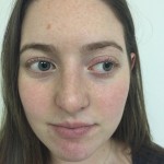 Rhinoplasty Before & After Patient #5012
