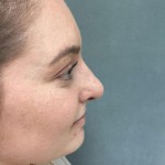 Rhinoplasty Before & After Patient #5012