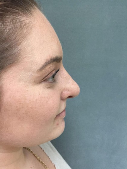 Rhinoplasty Before & After Patient #5012