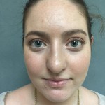 Rhinoplasty Before & After Patient #5012