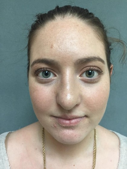 Rhinoplasty Before & After Patient #5012