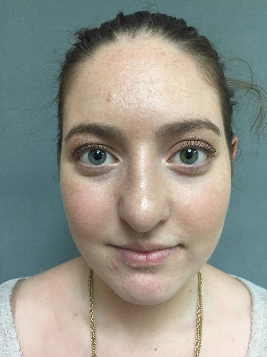 Rhinoplasty Before & After Patient #5012