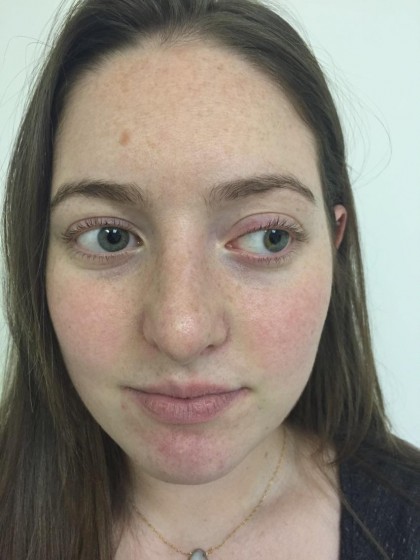 Rhinoplasty Before & After Patient #5012