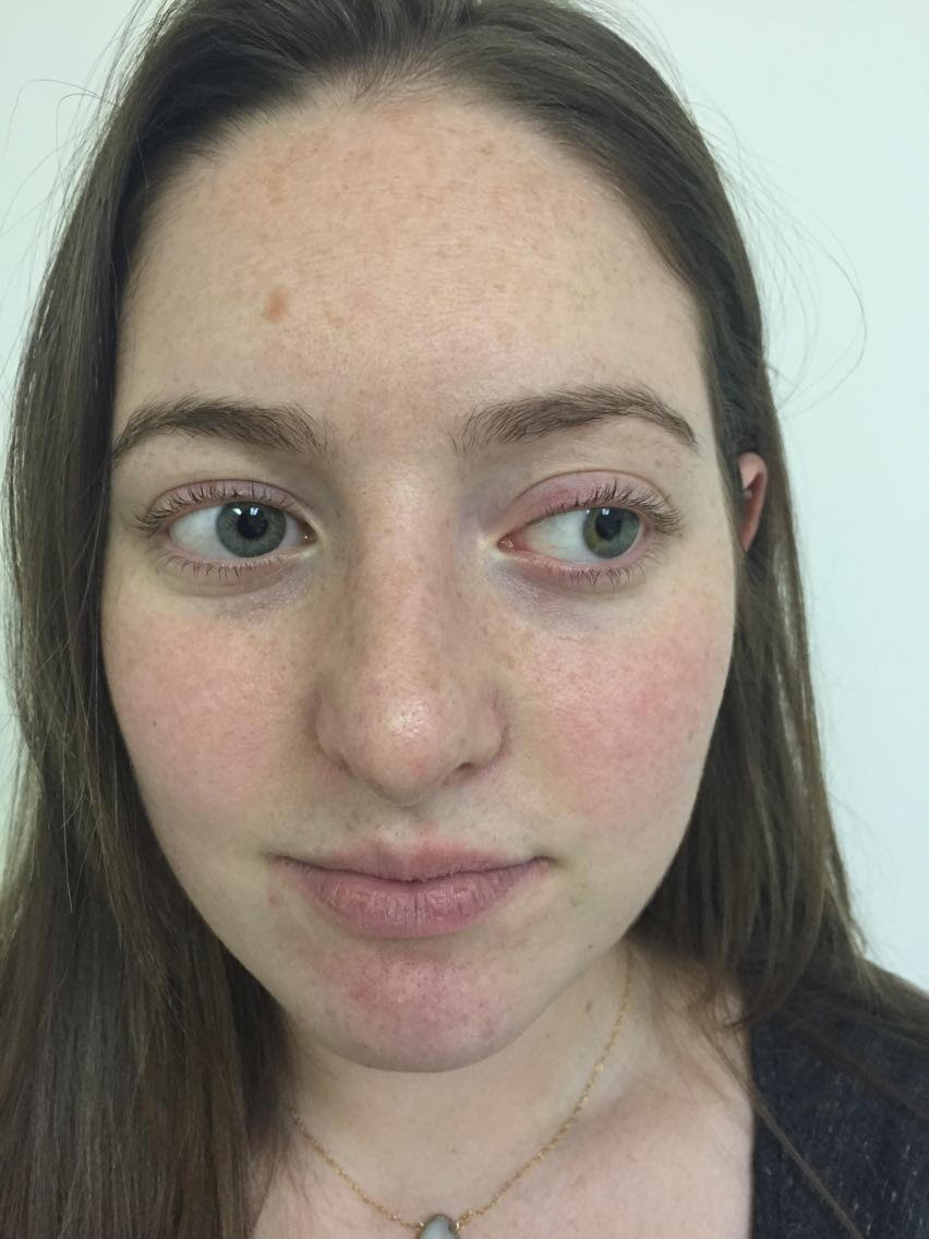 Rhinoplasty Before & After Patient #5012